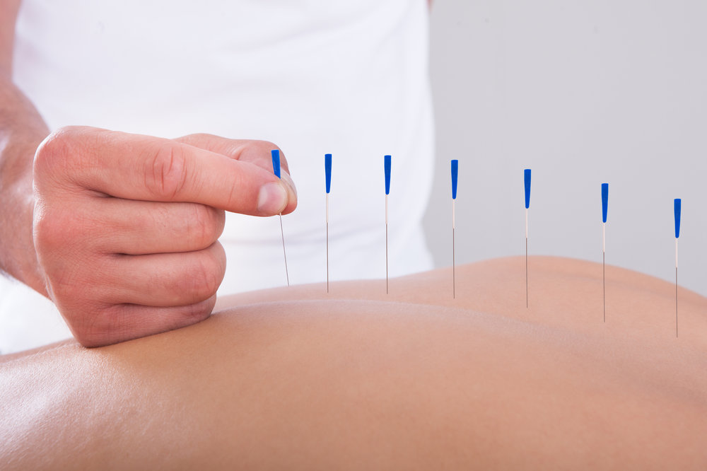 Important Things to Be Aware of About Acupuncture